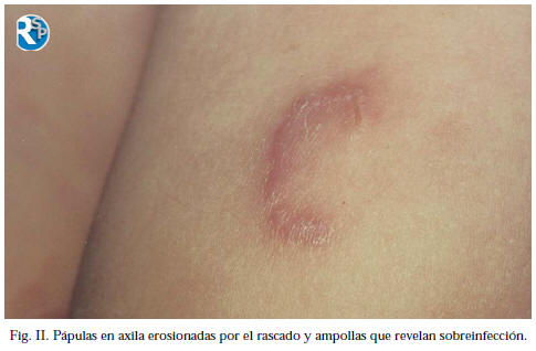 Qaraderma - Dermatología & Estética - La escabiosis, también conocida como sarna  humana, es la enfermedad producida por la presencia de los ácaros en la  piel del hombre llamada Sarcoptes scabiei. Esta